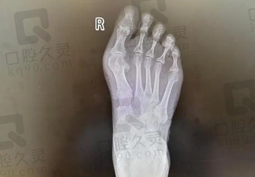 广州广大医院陈碧顺医生的拇外翻矫正技术怎么样？