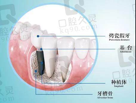 非常全的种植牙问题，为你一一解答!