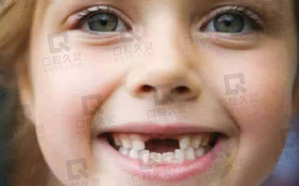父母注意啦！孩子12岁前必须处理的12种牙颌畸形