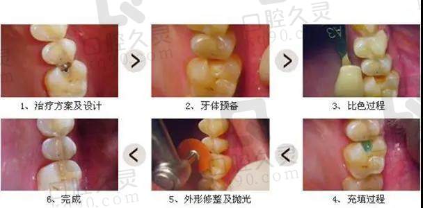 补牙和根管治疗，还傻傻分不清楚吗？