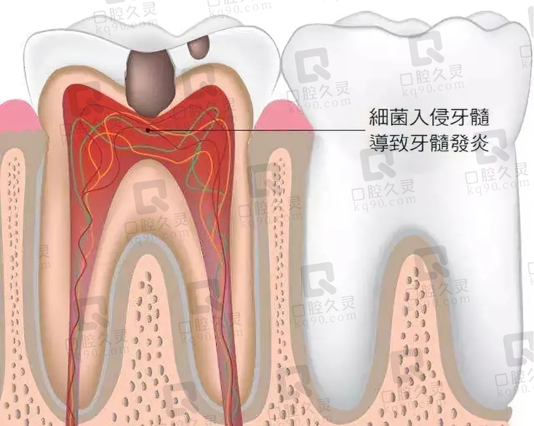 牙疼含口冰水就能好？