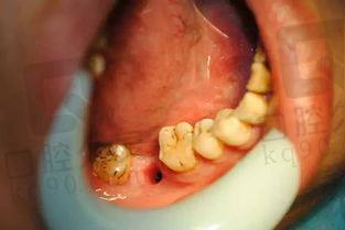 什么是种植牙？来看看做种植牙的全过程，记得平时要好好保护牙齿！