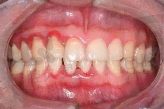 什么是牙周病？如何早期发现？