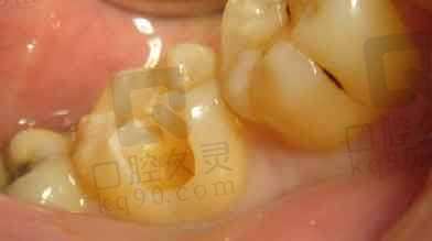 牙齿缺失用什么方法修复好？患者少了两颗牙？