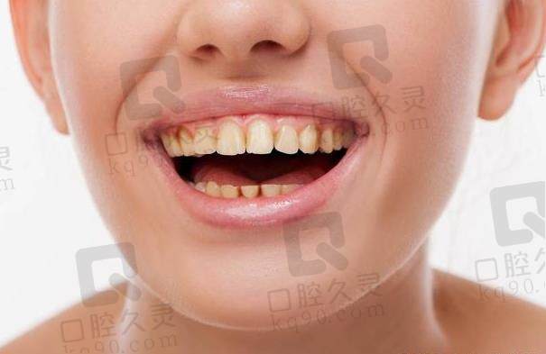 牙齿发黄很尴尬？4个导致牙齿发黄的行为，要避开！