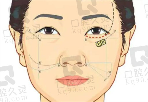 什么是面部整體年輕化手術(shù)