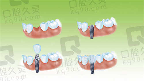 衡水可恩口腔医院种植牙