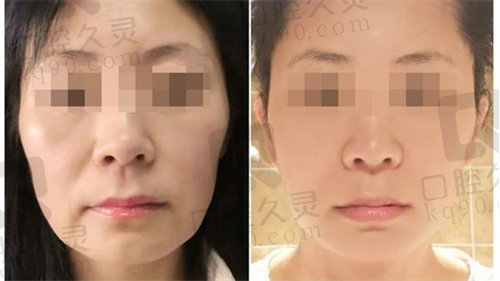 劉富增教丨授拉皮怎么樣 劉富增教丨授拉皮怎么樣