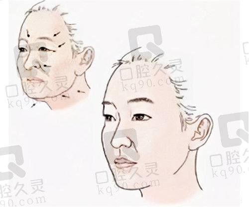 劉富增教丨授拉皮怎么樣 劉富增教丨授拉皮怎么樣