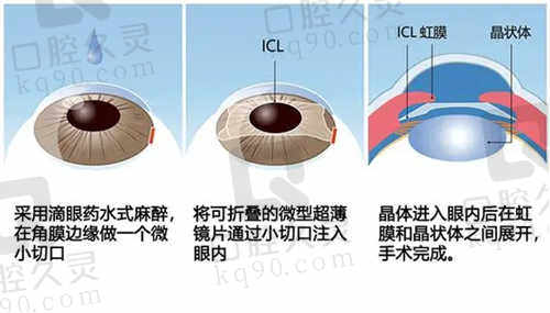 昆明华厦眼科医院ICL晶体植入手术