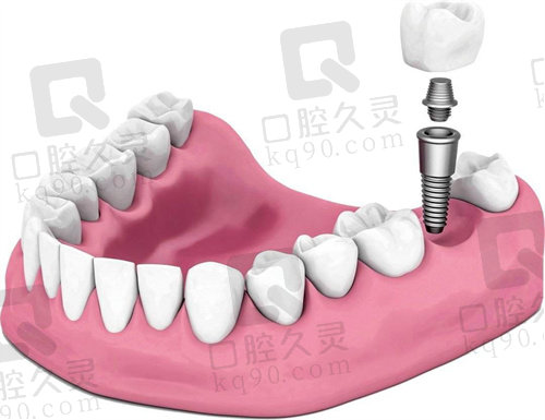 太原朝阳口腔医院种植牙怎么样