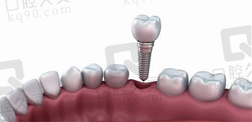 太原朝阳口腔医院种植牙价格