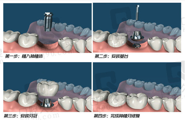 阳泉康贝齿科医院赵医生特色技术