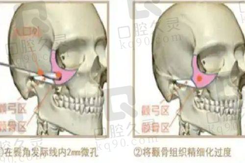 术后成效如何？