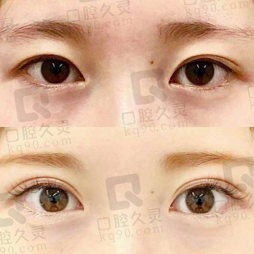 呼和浩特韩赋医疗美容做双眼皮多少钱？2025价格表揭秘埋线、切开等手术费用 
