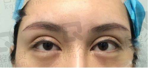曾繁茂双眼皮修复案例大揭秘：零失败神话背后，五维评估与精细操作铸就自然美眸！ 