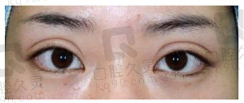 五、选择曾繁茂医生进行双眼皮修复的优势