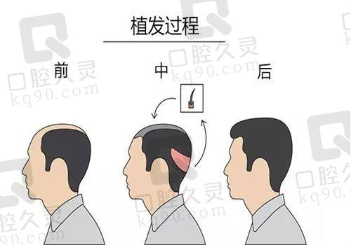 2025大麦植发部分地区及技术具体价格