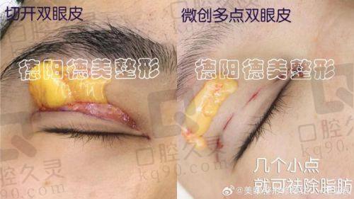 兰州罗梅双眼皮做的怎么样？20多年经验结合微创技术，自然风效果获患者好评！ 