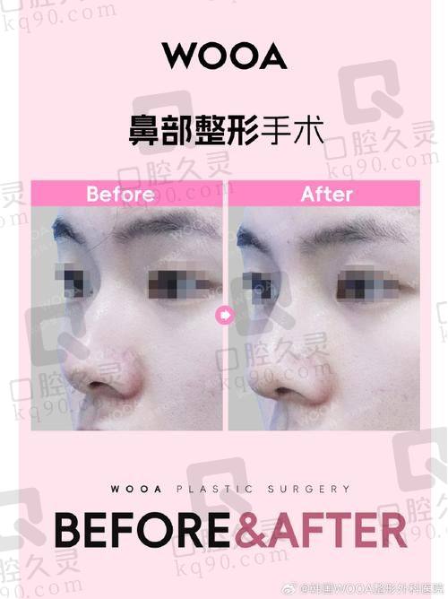 兰州时光激光整形美容医院贾治兰医生做双眼皮和隆鼻怎么样？