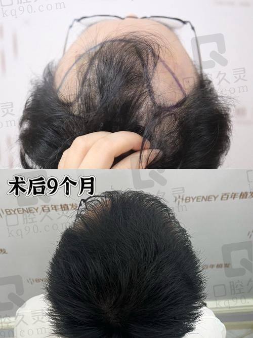 2025大麦植发优惠活动