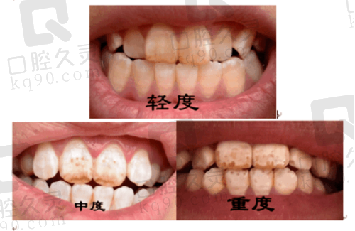 决定选择武汉咿呀口腔做假牙的过程