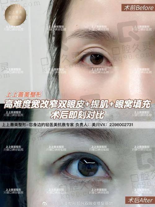 五、选择王克华医生修复全切双眼皮的注意事项