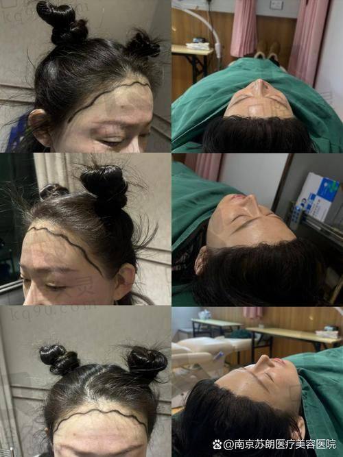 北京碧莲盛植发医院种植发际线的费用贵吗？