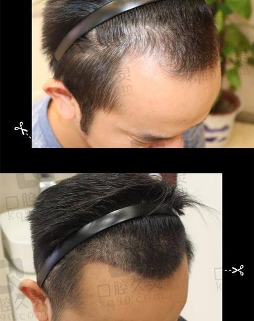 北京碧莲盛植发医院种植发际线的诊疗成效如何？