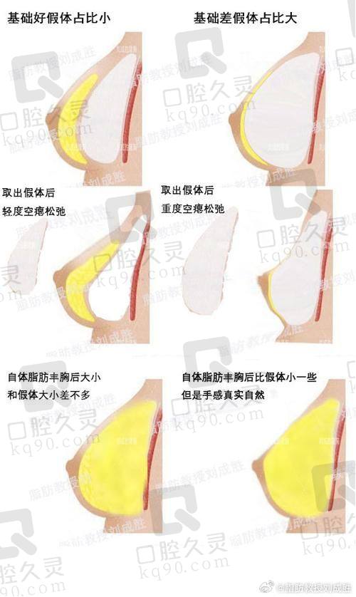 在成都八大处找栾杰做30000元假体胸，效果惊艳到我了！