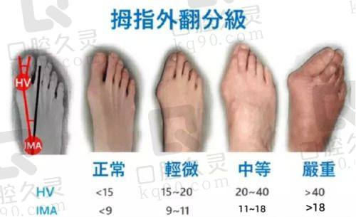 一、上海虹桥医院拇外翻手术费的大致范围
