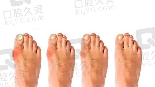 六、上海虹桥医院拇外翻手术的术前术后注意事项