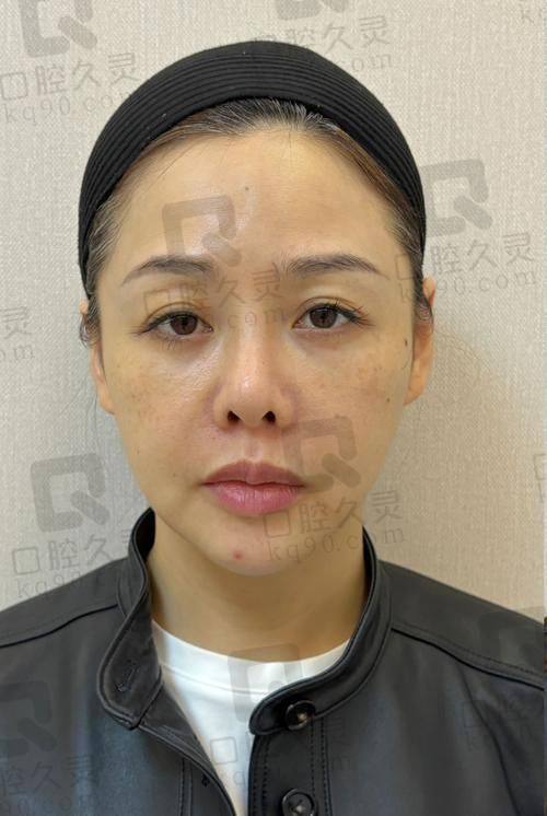 二、不同型号乔雅登玻尿酸价格及特点