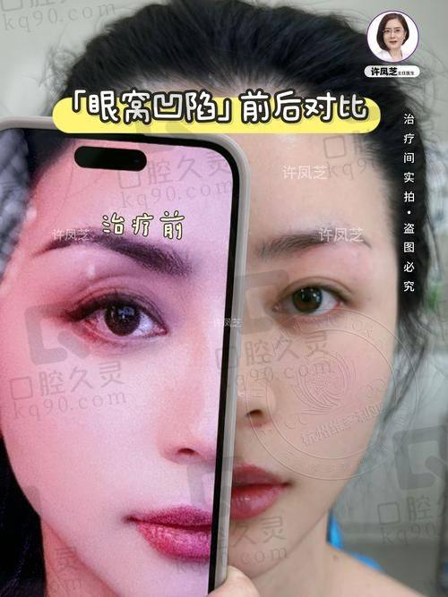一、2025年乔雅登玻尿酸价格整体情况