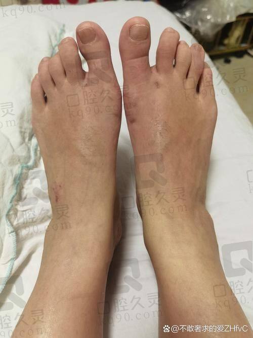 二、上海虹桥医院拇外翻手术费用的构成因素