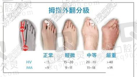 三、上海虹桥医院拇外翻手术的技术特色