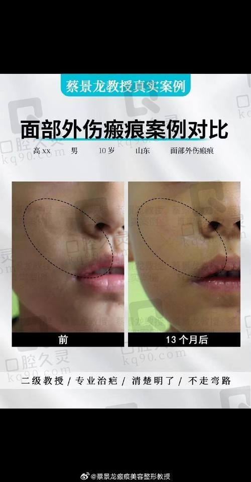 不同疤痕类型的方案选择