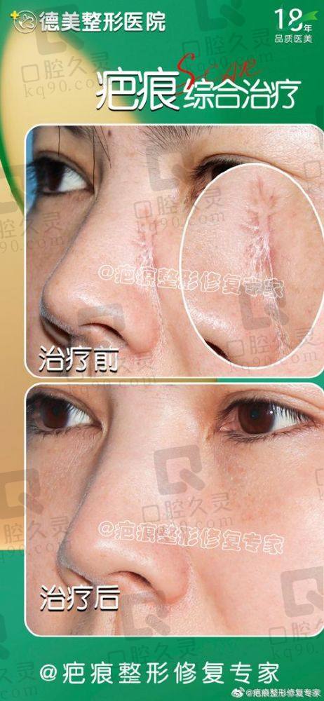 脸部疤痕修复费用情况