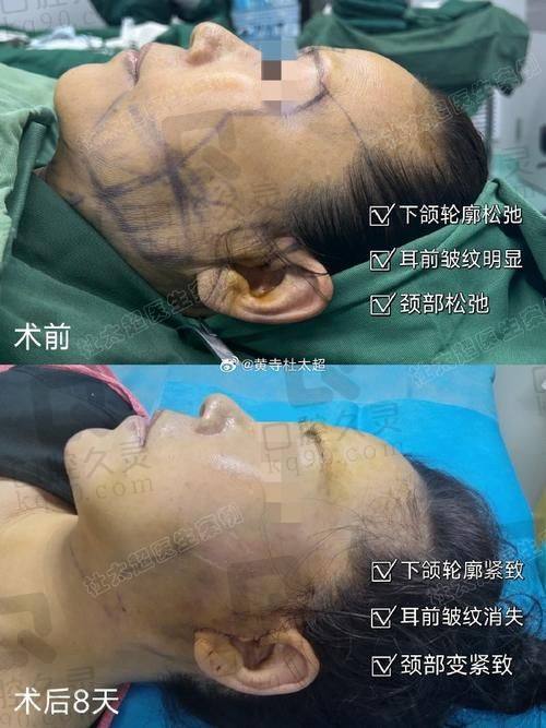 拉皮手术有哪些风险和注意事项？