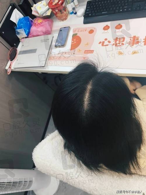 福州毛发科植发医院发际线种植原理科普