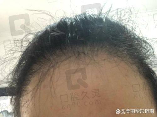 碧莲盛植发的其他服务与注意事项