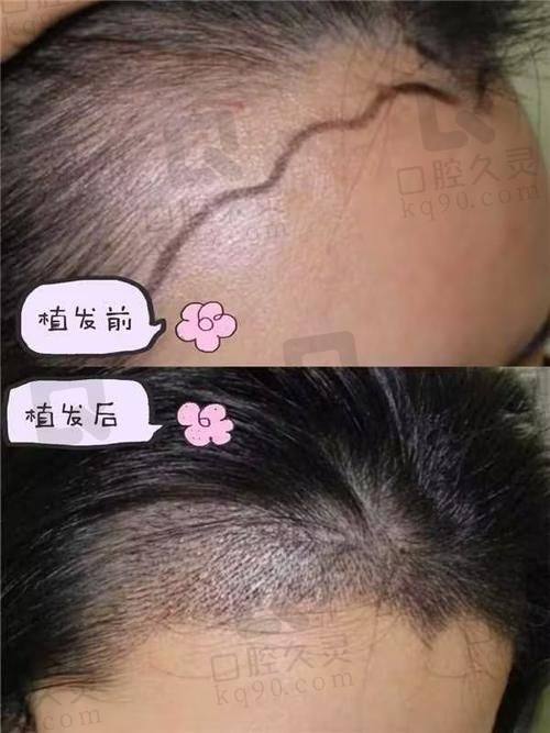 碧莲盛植发开展的项目与价格区间