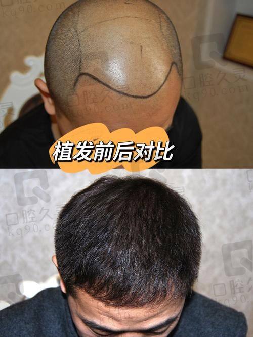 碧莲盛植发的正规性与医院概况