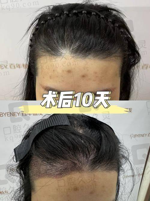 碧莲盛植发的技术实力特点