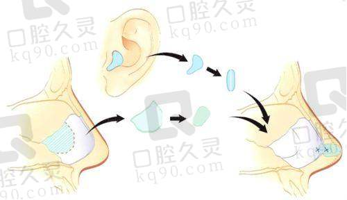 三、段伟强耳再造有名吗？临床经验来证明