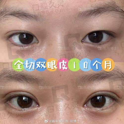 三、杨迪帕克双眼皮手术风格大揭秘
