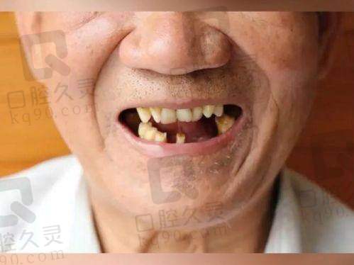 为什么选择太原鼎植口腔医院做全口活动义齿？