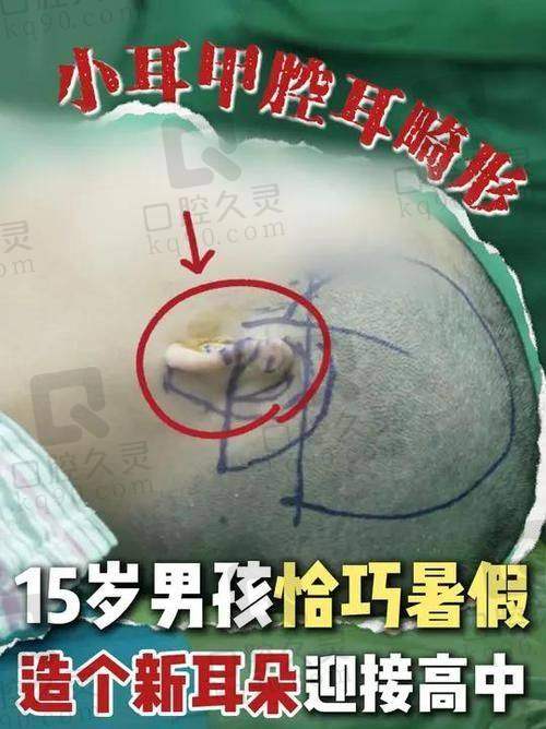 七、总结：段伟强耳再造有名吗？答案是肯定的