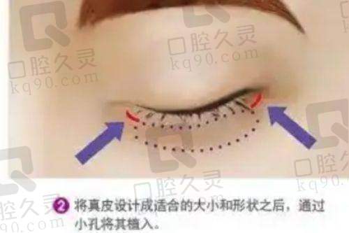 吸脂手术的注意事项