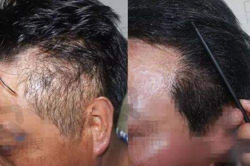 总结评价——太原碧莲盛医疗美容诊所（植发专科）怎么样？
